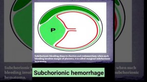 Placental imaging (pathological conditions of placenta part- 1)