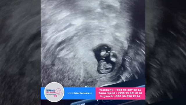 Namangandan kelgan juftlikimiz PCO tufayli EKU muolajasiga olingan edi Ikkita 5 kunlik embrion tran смотреть онлайн