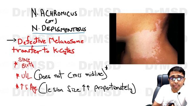 Vitiligo | Melanocyte destruction | Autoimmune disease | Michael Jackson | Melanin | Melanosomes |