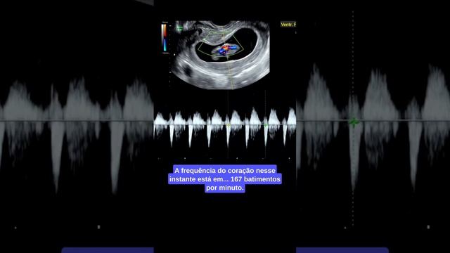 Bebê dentro da barriga - imagens 3D/4D #bebe #gravidez #gestação