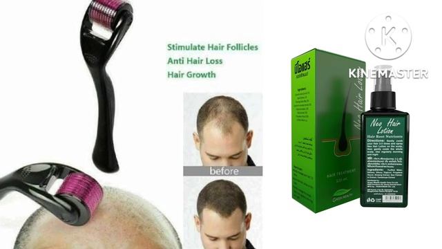 5 Big Mistake while Using Neo Hair Lotion & Derma Roller #neohairlotion, #hairloss #neohair #neooil смотреть онлайн