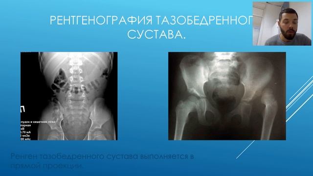 Профилактика первичных ортопедических осложнений при Spina Bifida