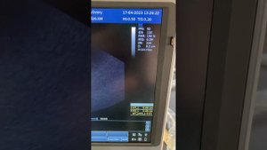 Обзор узи аппарата Chison  Sonotouch 60