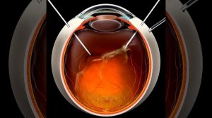 Витрэктомия | Центр лазерной медицины
