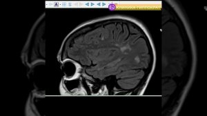 Рассеянный склероз. МРТ от А до Я