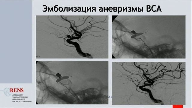Свистов Д. В., «Исторические аспекты развития эндоваскулярной технологии лечения церебрал. аневризм