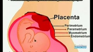 Parto 43enne, dopo 3 fibromi, con placenta accreta e sindrome di Gitelman. Una sfida impossibile