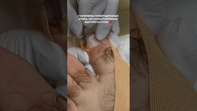 УДАЛЕНИЕ ВРОСШЕГО НОГТЯ Как вам? Сталкивались с такой проблемой? #подолог #здоровье
