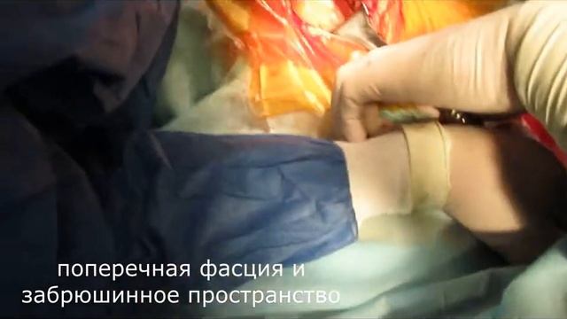 Lumbar sympatectomy (left side). Поясничная симпатэктомия слева.