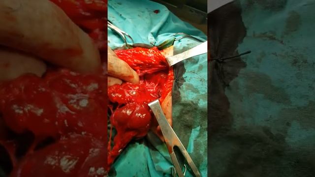 Киста шеи или мтс рака щитовидной железы смотреть онлайн