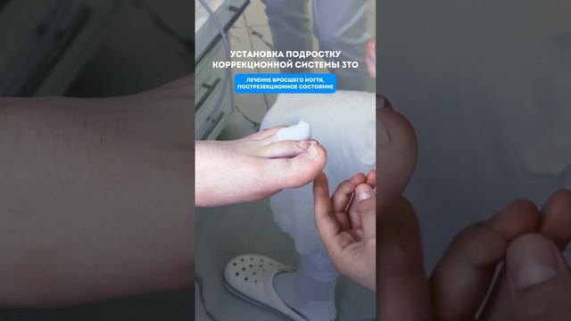 УСТАНОВКА 3ТО Лечение вросшего ногтя У ПОДРОСТКА #подологмосква #подолог