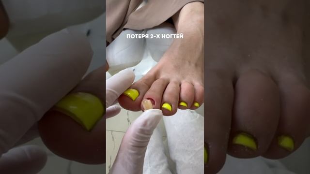 ТРАВМА НОГТЯ гель-лак и неправильная обувь #подолог #москва Что случилось узнайте в комментариях