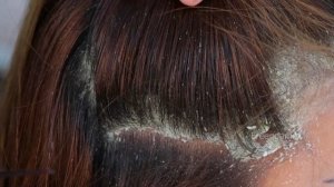 Itchy Dry Scalp!! Dandruff Removing Huge Flakes Satisfying #