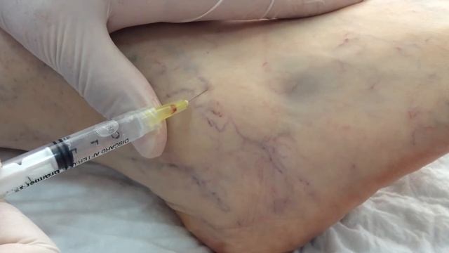 Ayaqda yaranan kapilyarlarin mualicesi nece edilir Skleroterapiya ne demekdir Bakida damar hekimi смотреть онлайн