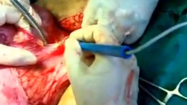 Массивная фибромиома матки смотреть онлайн