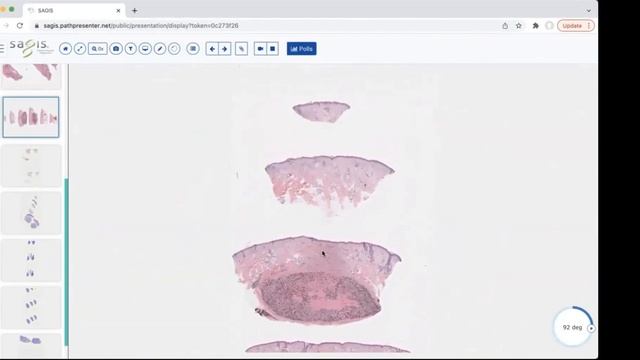 Granulomatous Dermatitis / May 2022 \ Dermpath Happy Hour смотреть онлайн