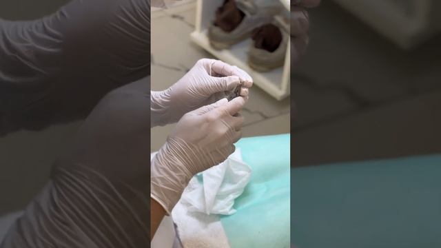 Вросший ноготь: лечение с помощью скобы Фрезера #подолог #подологмосква