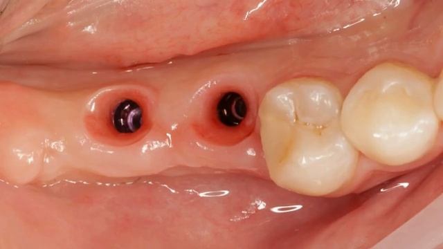 Отсроченная имплантация 4 6 и 4 7 смотреть онлайн