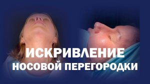 Риносептопластика: результат сложной пластики носа на разных этапах