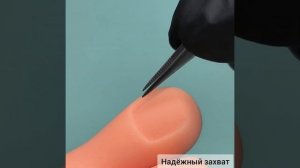 Вросший ноготь.Удаление вросшего ногтя осколочным пинцетом
