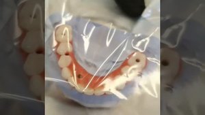 Несъемные протезы All on 4 / All on four - все зубы на 4 имплантах за 1 день. Неватекс отзывы