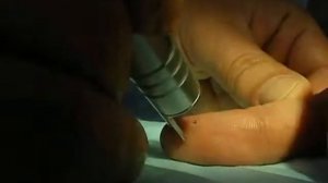 Удаление бородавки