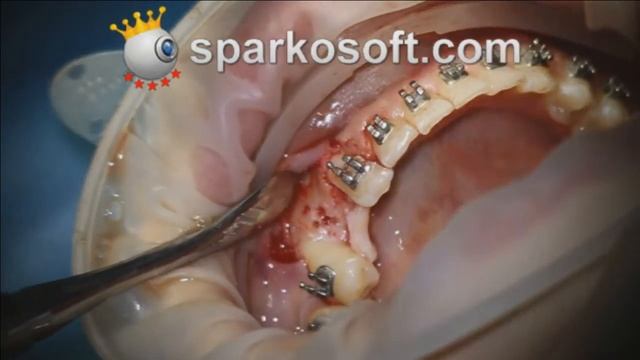 Bone Grafting And Tissue reconstruction in Hellas Dental. смотреть онлайн
