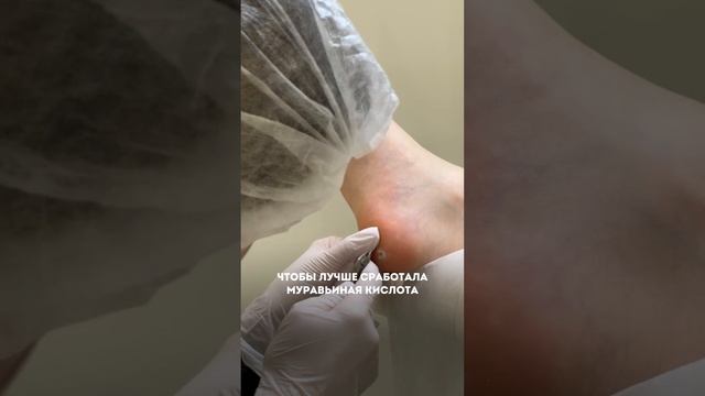 В комментариях рассказали про подошвенные бородавки #подолог #москва #дети