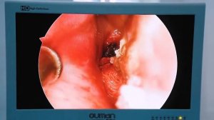 Bemorimiz 3 operatsiyani o'tkazdi Adenotomiya + Gaymorotomiya + Septoplastika