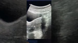 Может ли эмбрион после переноса выпасти из полости матки?