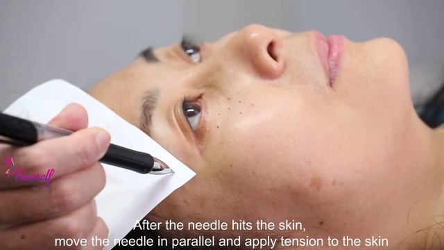 Trueself PLLA Dermal filler used for lacrimal groove