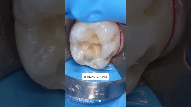 Коричневые пятна на постоянном зубе ребёнка. Что это? Кариес? Налет? Как избежать этого?