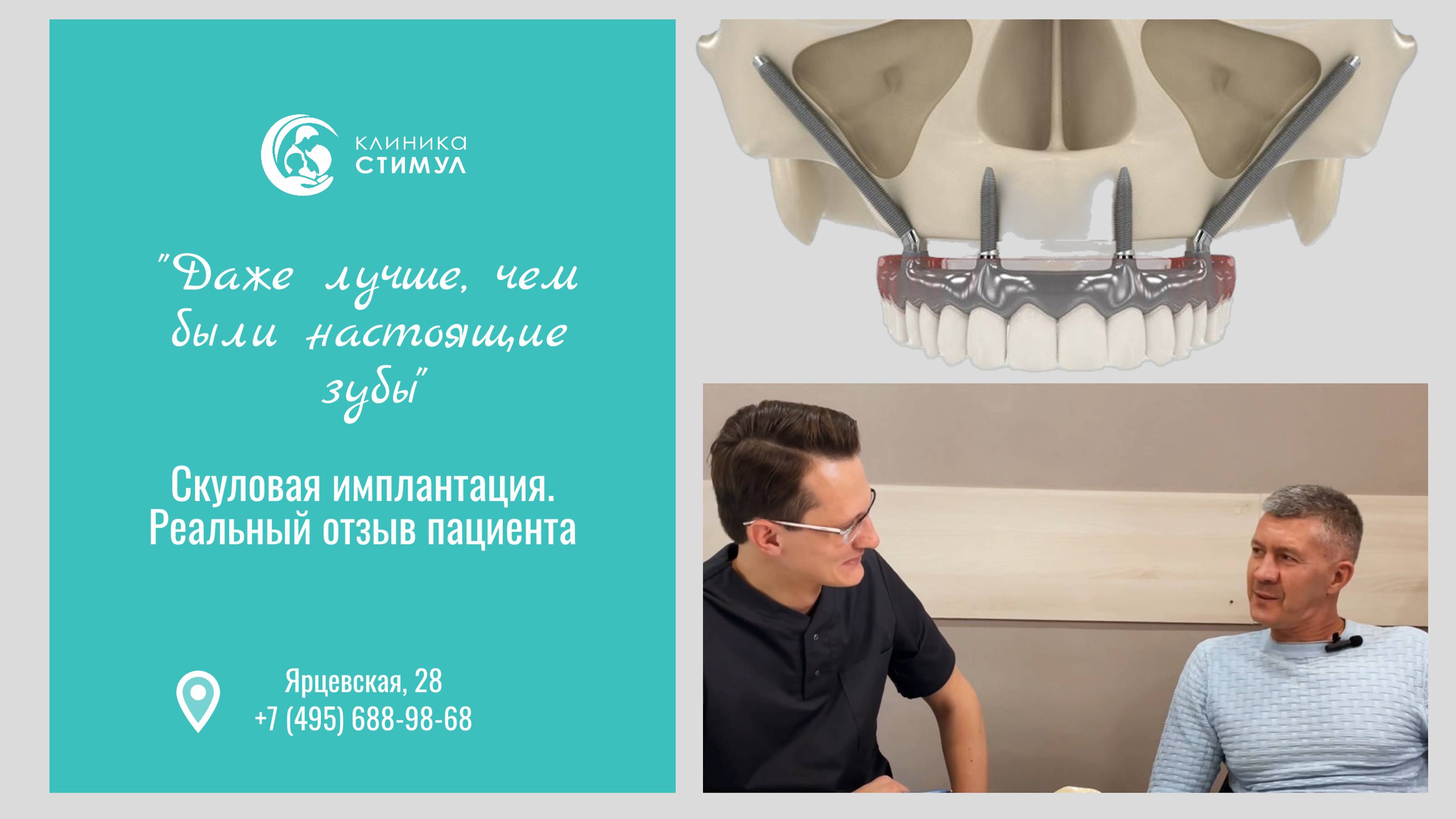 Скуловая имплантация зубов - Отзыв пациента и описание услуги | хирург-имплантолог Трохалин А.В.