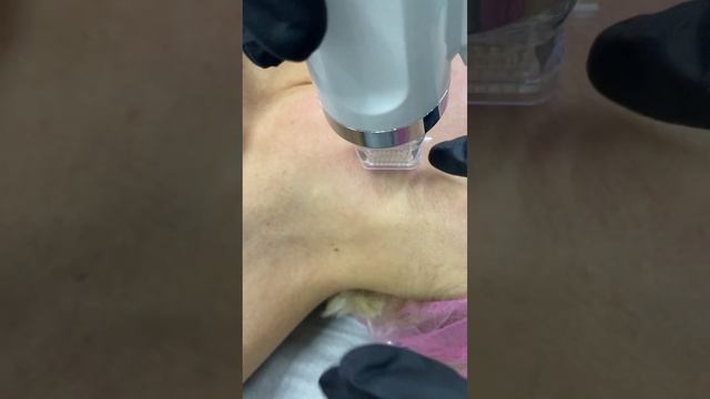 Семинар «Микроигольчатый Рф-лифтинг». Постановка рук
