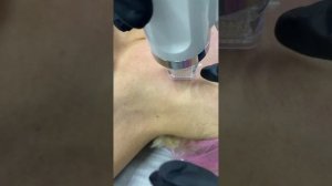 Семинар «Микроигольчатый Рф-лифтинг». Постановка рук