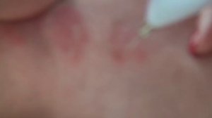 Mole pen plasma pen без анастезии больно и жжет чувствительно