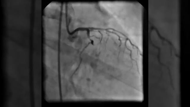 Ангиограмма ЛКА (исходно). Огибающая ветвь представле смотреть онлайн