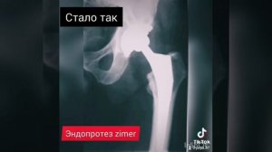 эндопротезирование. замена сустава.никроз головки бедренной кости