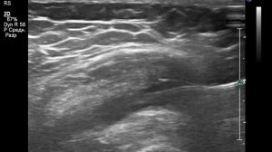 Внутрисуставное введение гиалуроновой кислоты в коленный сустав под узи,knee injection by ultrasoun