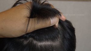 Dandruff Removal Big Flakes On Front Side!!! Dandruff Scratching Satisfying #312