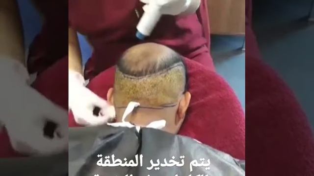 التخدير الحديث في زراعة الشعر بدون اي الم وبدون استخدام الحقن التقليدية (الابر) 2 смотреть онлайн