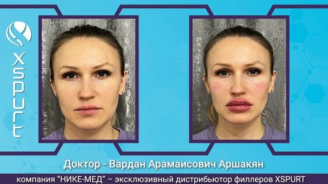 XSPURT - линейка монофазных, полиденсифицированных филлеров V поколения