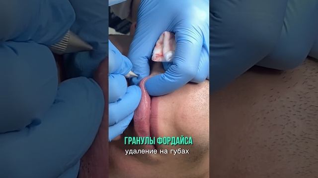 ГРАНУЛЫ ФОРДАЙСА - удаление на губах. #клиникамосква #гранулыфордайса #гранулы #удаление #fyp