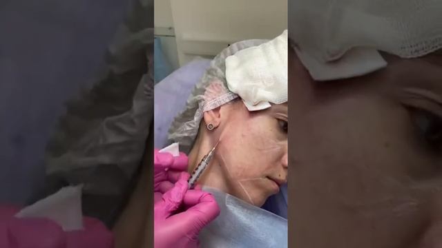 Омоложение лица - коллагеностимуляция препаратом на основе полимолочнлй кислоты Aesthefill в Сочи