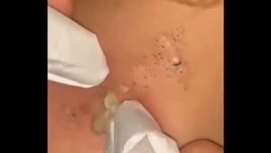 Big blackheads залипательное видео 2022, черные точки давим
