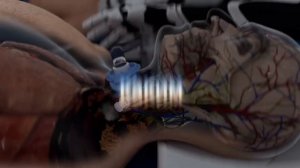 Пересадка головы. Возможно сегодня?