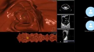 ВИРТУАЛЬНАЯ ФИБРОКОЛОНОСКОПИЯ ДЛЯ СКРИНИНГА ОПАСНЫХ ЗАБОЛЕВАНИЙ ТОЛСТОЙ КИШКИ