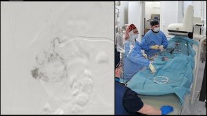 Эмболизация гемангиомы печени