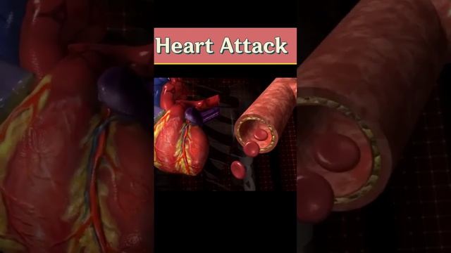 Cause Of Heart Attacks and Stroke I Aspirin and Strokes New Video!