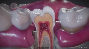 Отбеливание зубов (видео для стоматолога)